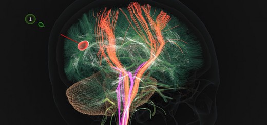 hdr-atlas-meditech-brain-surgery-ai-digital-twins-720x340